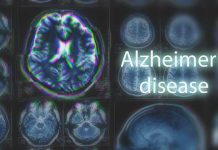 Alzheimer’s Test WARNING: Kidney Patients Targeted Next MRI brain scan highlighting Alzheimer's disease